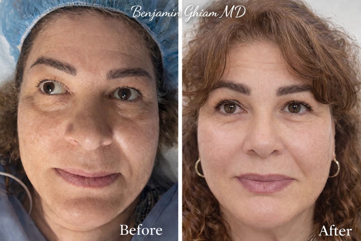 Patient with exotropia before strabismus surgery on the left, and the same patient with corrected eye alignment after surgery on the right